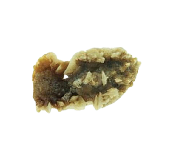 Struvite Stones