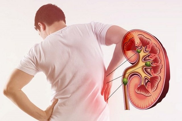 Kidney Stone Treatment
