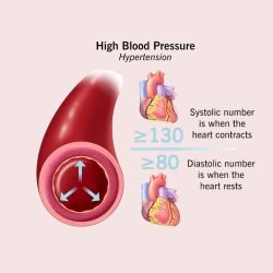 Dialysis Treatment