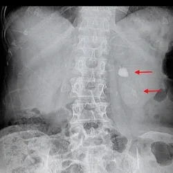 Kidney Stone treatment in mumbai, maharashtra